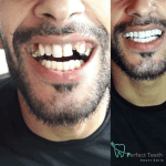 Perfect teeth - Smart smile-Koopje.com
